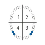 Щипцы для удаления нижних зубов 140-13 Schwert